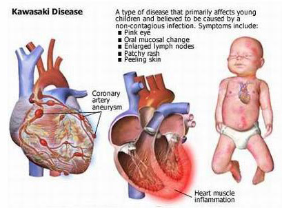 emne Sydamerika Teasing What is Kawasaki Disease? | www.kawasakidiseaseindia.org
