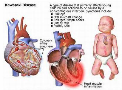 kawasaki arteritis